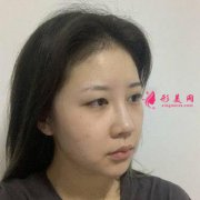 上海華美整形醫(yī)院雙眼皮好嗎？分享：術后兩個月前后效果對比