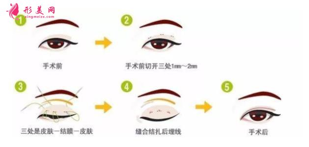 全切雙眼皮痛嗎？是局麻還是全麻？