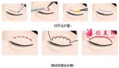 全切雙眼皮痛嗎？是局麻還是全麻？