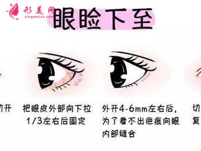 眼綜合手術(shù)有幾項(xiàng)