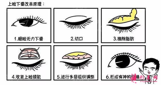 眼綜合手術(shù)有幾項(xiàng)