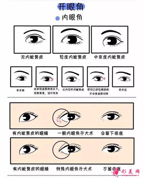 眼綜合手術(shù)有幾項(xiàng)