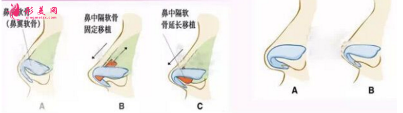 自體軟骨隆鼻尖價(jià)格