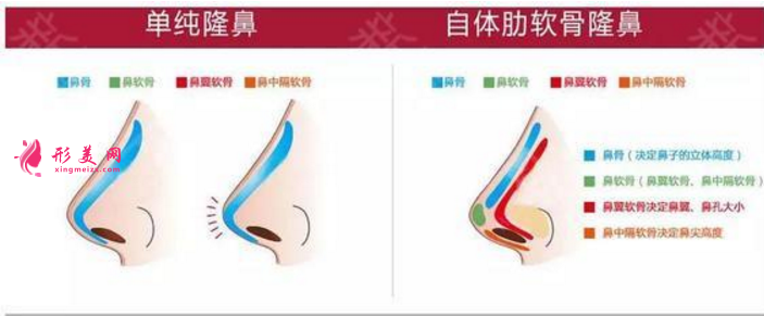 自體軟骨隆鼻尖價(jià)格