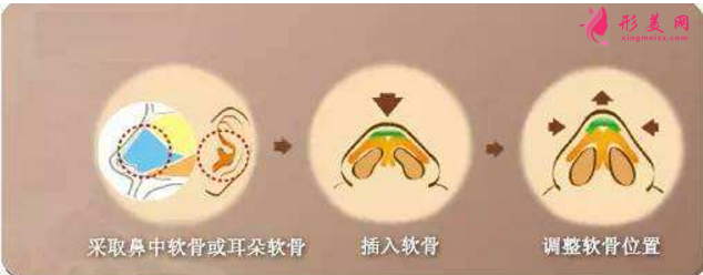 自體軟骨隆鼻尖價(jià)格