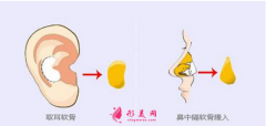 自體軟骨隆鼻尖價格是多少？術后注意事項~