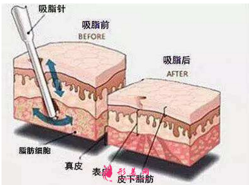 減肥吸脂術(shù)對身體的傷害