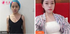 杭州整形醫(yī)院自體脂肪隆胸貴嗎?附自體脂肪豐胸術(shù)后效果分享