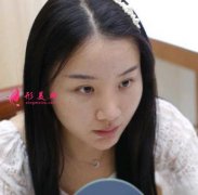 北京潤美玉之光醫(yī)療美容小仙女鼻綜合手術(shù)一年恢復(fù)對(duì)比圖