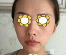 北京純脂整形醫(yī)院做全臉填充多少錢？附真實(shí)案例~