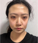 成都趙善軍面部脂肪填充如何？真實(shí)案例分享！