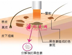 激光祛斑需要做多少次才有效果？