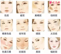 激光祛斑會(huì)有疤痕嗎？