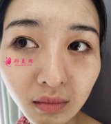 武漢美麗爾整形玻尿酸墊下巴案例分享_術(shù)后15天真實圖片一覽