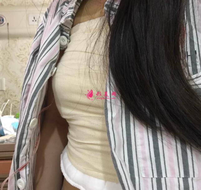 隆胸術(shù)后3天