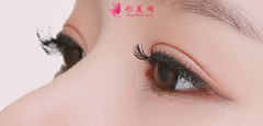 雙眼皮手術(shù)失敗修復(fù)難度大嗎？
