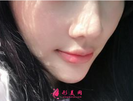 瘦臉針打完后有副作用嗎