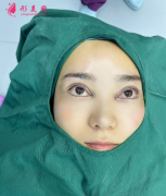 北京葉子整形醫(yī)院做雙眼皮怎么樣，成就你的自然美