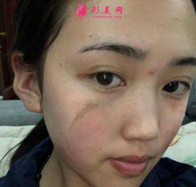 在北京301整形醫(yī)院找雷永紅醫(yī)生做手術(shù)祛疤手術(shù)前