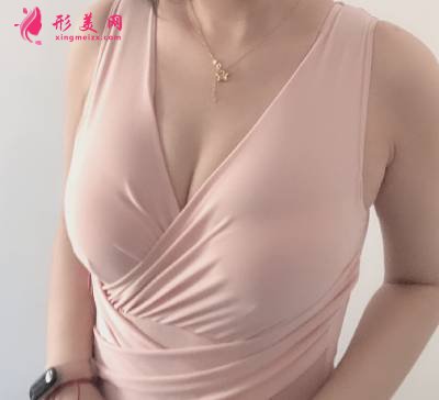 王志強院長為我做的自體脂肪隆胸手術(shù)后200天·