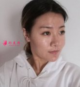 成都軍建醫(yī)院做自體脂肪豐面頰手術后，滿臉的膠原蛋白~