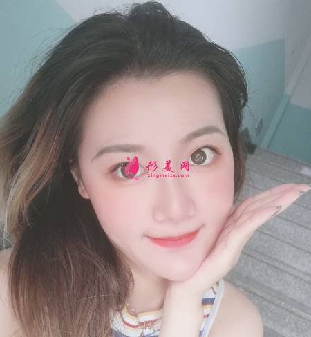 找成都軍建醫(yī)院的呂婧做自體脂肪豐面頰手術(shù)后1個月