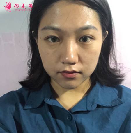 成都軍建醫(yī)院楊俊給我做膨體隆鼻后