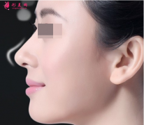 硅膠隆鼻時(shí)間長(zhǎng)了要取出嗎？