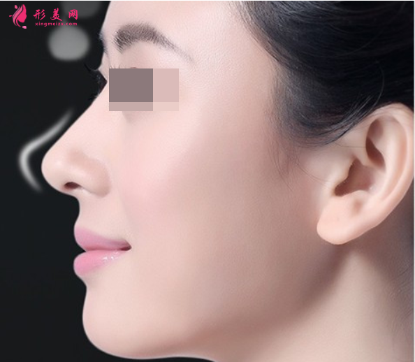 硅膠隆鼻時(shí)間長(zhǎng)了要取出嗎