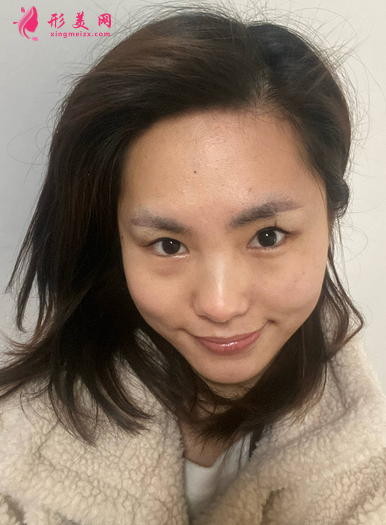 找成都美綻美整形美容醫(yī)院陳宇做的眼綜合，案例|價(jià)格分享給大家