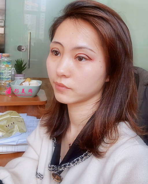 找成都美綻美整形美容醫(yī)院陳宇做的眼綜合，案例|價(jià)格分享給大家
