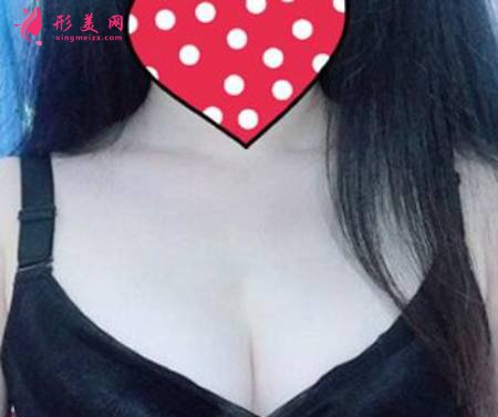 找成都圣丹福找張雪峰做了曼托275CC假體隆胸手術(shù)后3個月