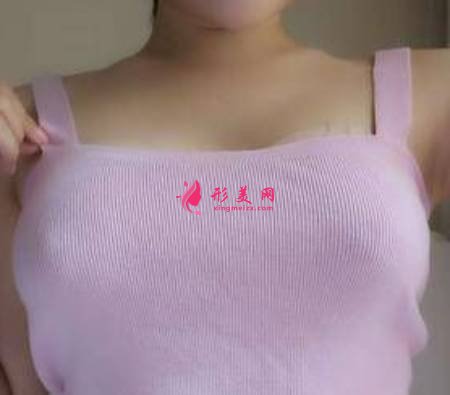 找成都友誼找黃國強(qiáng)做了自體脂肪隆胸手術(shù)后
