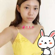 在重慶華美整形醫(yī)院做假體隆胸手術(shù)，100天恢復(fù)日記分享