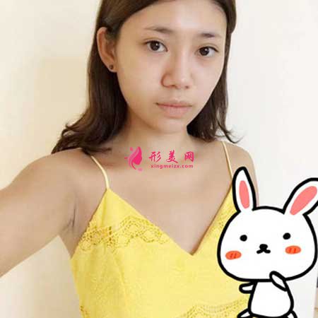 找重慶華美做找陳德法做假體隆胸手術(shù)前