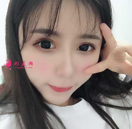 自體脂肪面部填充手術后45天