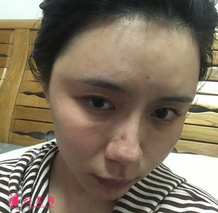 自體脂肪面部填充手術后15天