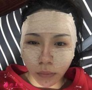 重慶華美整形醫(yī)院給我做的自體脂肪面部填充手術，90天恢復效果