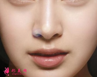 鼻翼縮小手術(shù)的恢復(fù)期長嗎