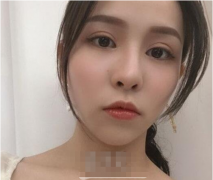 上海耳軟骨鼻綜合過(guò)程展示｜恢復(fù)60天效果圖一覽~