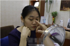 西安西京整形醫(yī)院隆鼻案例分享|親身效果圖展示~