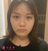 解放軍第九二醫(yī)院整形科雙眼皮修復(fù)案例分享，附術(shù)后183天效果展