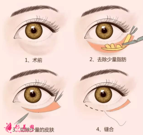 手術(shù)祛眼袋的費用要多少