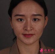 重慶軍科整形雙眼皮修復(fù)1-90天恢復(fù)過程詳解
