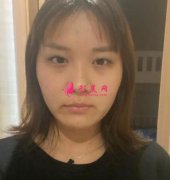 解放軍第九二醫(yī)院整形科雙眼皮修復(fù)案例分享，附術(shù)后183天效果展