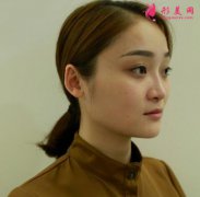 上海伯思立整形醫(yī)院隆鼻怎么樣？案例效果分享