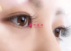 雙眼皮手術(shù)大概要多少錢？