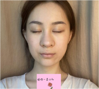 北京八大處范飛醫(yī)生隆鼻怎么樣？真實(shí)案例一覽~