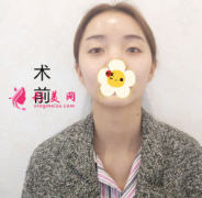 上海美萊整形醫(yī)院眼綜合整形性價比很高 眼睛大了好多呀
