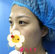 佛山美萊整形醫(yī)院做的雙眼皮修復(fù)手術(shù)怎么樣？